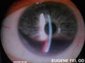 Eye trauma causes bleeding in the anterior chamber inside the eye (Hyphema)